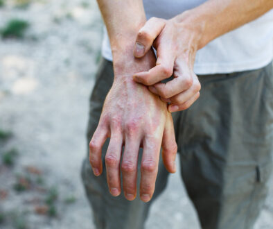 Closeup of a Man Scratching His Swollen Hand With Red Spots on It What Are the Early Warning Signs of Psoriatic Arthritis