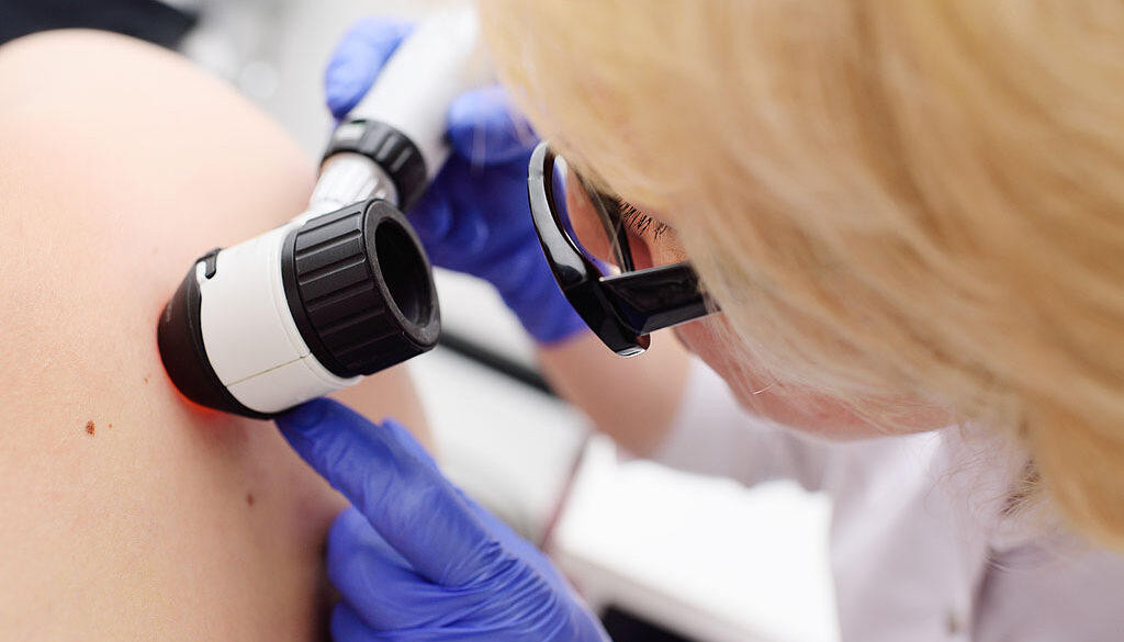 Closeup of a Dermatologist Using a Device to Inspect a Mole on a Patient’s Back Is Skin Cancer Genetic